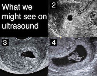 when should you have a dating ultrasound